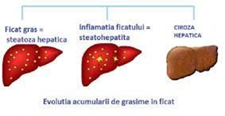 Steatoza hepatică